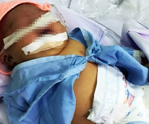 Bé gái nặng 4kg nhưng cho sinh thường ở Bình Thuận bị tổn thương thần kinh cánh tay và hôn mê