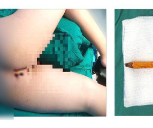 Ớn lạnh hình ảnh bé trai bị bị bút chì đâm thấu mông đến 8 cm