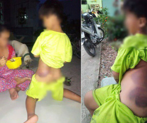 Mẹ học sinh lớp 1 khuyết tật bị giáo viên đánh bầm tím người: 'Đừng đuổi việc cô, do cô thương nên mới đánh bé'