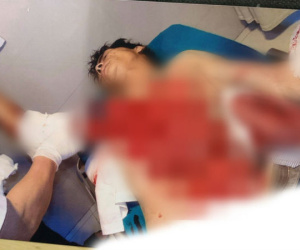 Tai nạn kinh hoàng: Ngã vào máy bóc gỗ, người đàn ông bị lột toàn bộ da phần ngực và tay