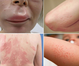 Cẩn thận kẻo trời lạnh quá sẽ khiến bạn mắc phải chứng dị ứng có thể gây chết người này