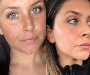 Bức ảnh trước - sau này chính là minh chứng thuyết phục nhất cho sự kỳ diệu của serum vitamin C và kem chống nắng