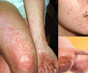 Trời lạnh, có thể chết vì dị ứng thời tiết