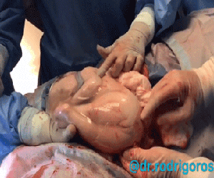 Chào đời nhưng em bé vẫn nằm ngủ ngon lành trong túi ối, mặc kệ thế giới mình vẫn đang buồn ngủ lắm
