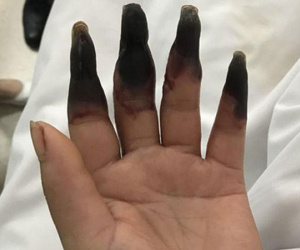 Dọn nhà, người phụ nữ bị hoại tử 8 ngón tay đen sì: Triệu chứng bất thường mọi người phải hết sức cảnh giác