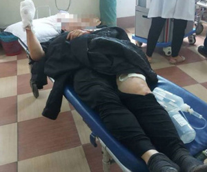Tài xế xe ôm chém đứt lìa tay chủ quán ăn