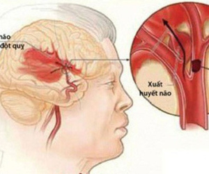 Chủ tịch hội đột quỵ Việt Nam: 5 dấu hiệu cảnh báo đột quỵ bất cứ ai cũng phải thuộc lòng