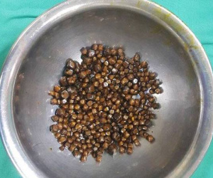 Kinh hoàng bệnh nhân mang gần 400 viên sỏi trong túi mật