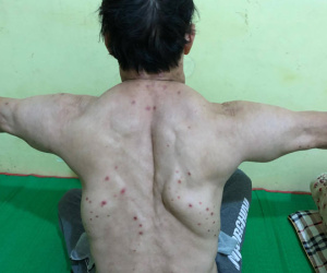 Uống rượu nhiều năm, 3 người đàn ông mắc bệnh lạ, khối u khủng mọc chi chít