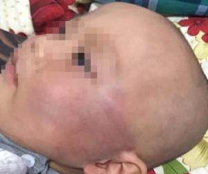Vụ bé trai 19 tháng tuổi bị bảo mẫu tát sưng mặt: Gia đình không chấp nhận lời xin lỗi