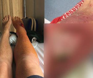 Rùng mình, bác sĩ thả 400 con giòi vào chân để ăn thịt chữa bệnh