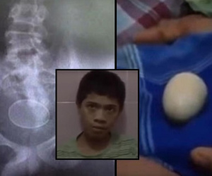 KHÓ TIN: Cậu bé người Indonesia đẻ 20 quả trứng đều đặn trong 2 năm