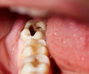 Người phụ nữ ở Phú Thọ suýt chết khi chữa sâu răng