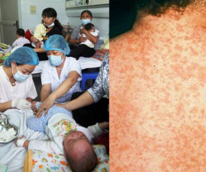 Hà Nội: Thêm 23 ca mắc sởi, không tiêm vắc xin dễ mắc bệnh