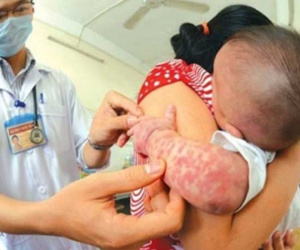 Cảnh báo: Một tuần Hà Nội ghi nhận 78 trường hợp mắc sởi