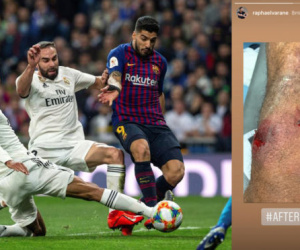 Hình ảnh gây sốc ở đầu gối của Varane sau trận gặp Barca