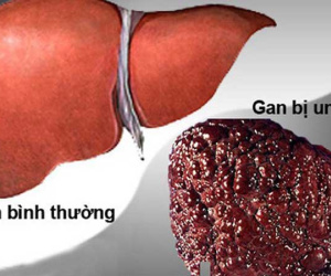 Ung thư gan đứng đầu trong các bệnh ung thư ở VN: GĐ BV Ung bướu chỉ 5 dấu hiệu cảnh báo