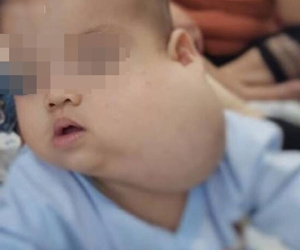 Người mẹ Sài Gòn đau khổ tột cùng vì con trai 12 tháng tuổi mang 'gương mặt quỷ', má phình to như quả bưởi