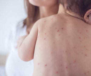 Bạn có thể chết vì bệnh sởi - Đây chính là lý do giới chuyên gia rất lo lắng về những đợt bùng phát bệnh gần đây