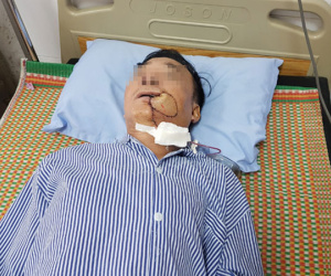 Tưởng bị nhiệt miệng, người đàn ông Hà Nội phải cắt 1 góc má vì ung thư