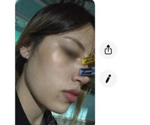 Muốn đẹp không tốn kém, cô gái trẻ tin lời 'chị em cây khế' tư vấn dùng kẹp quần áo để nâng mũi