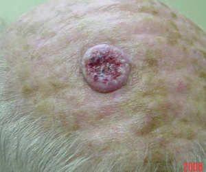 Chiếc lỗ đẫm máu trên đầu người đàn ông này chính là dấu hiệu cảnh báo một loại ung thư da nguy hiểm