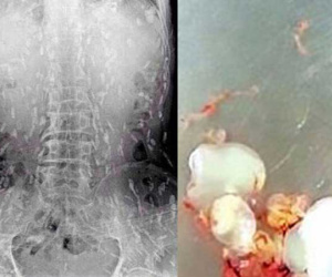Người nhiễm sán toàn cơ thể, người nhung nhúc trứng sán dây trong não: Những bài học đau đớn từ thói quen ăn đồ tái, sống