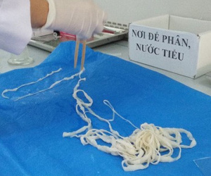 'Bắt' sán dây dài hơn 5 m khỏi cơ thể nữ giáo viên