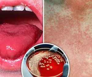 Lưỡi đỏ tươi khi sốt, cảnh báo căn bệnh cực kỳ nguy hiểm
