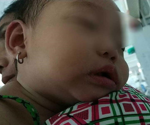Kawasaki, bệnh lạ nguy hiểm