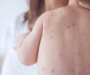 Vắc-xin có thể bảo vệ khỏi bệnh sởi, nhưng bạn cũng cần biết bệnh sởi lây qua đường nào