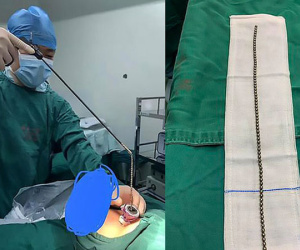 Cậu bé 11 tuổi nhét chuỗi 70 viên bi vào ‘cậu nhỏ’