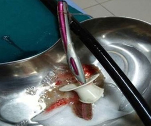 Hóc xương cá dùng bàn chải đánh răng 'giải cứu' rồi nuốt cả vào bụng