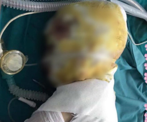 Xót xa cảnh bé trai dân tộc 9 tuổi bị ngã vào bếp củi, bỏng nặng toàn bộ khuôn mặt: 'Lúc ấy tôi không khóc nổi, nhìn con mà đau...'