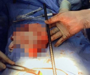 Lâm Đồng: Phẫu thuật thành công, lấy thanh sắt dài 65cm đâm xuyên ngực bệnh nhân