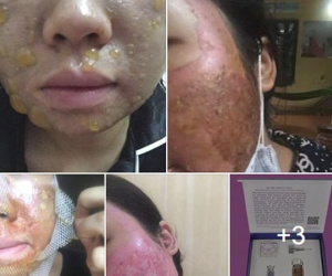 Kinh hãi hình ảnh cô gái bị nổi bóng nước khắp mặt vì làm đẹp: Chuyên gia cảnh báo điều quan trọng trước khi peel da
