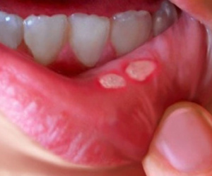 12 cách chữa nhiệt miệng