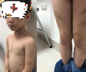Hà Nội: Mẹ ruột tố con trai lớp 1 bị mẹ kế bạo hành bằng dép và gậy khiến bé bầm tím cả người