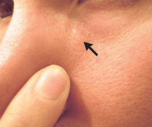Người đàn ông suýt mù vì giun chỉ dài 15 cm ký sinh trong mắt