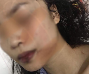 Bắc Ninh: Cô gái 18 tuổi bị bạn cũ lao vào phòng rạch mặt, cổ và tay, phải khâu 60 mũi