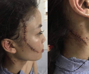 Chị gái thiếu nữ xinh đẹp bị rạch mặt: 'Em tôi kêu có thai mà họ vẫn không tha'