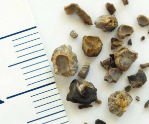Muốn loại bỏ sỏi thận triệt để: Quan trọng nhất là 'giữ mồm giữ miệng' trước những món này