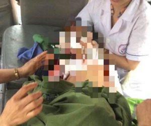 Lại một cháu bé bị chó nhà nuôi cắn dập nát cơ thể