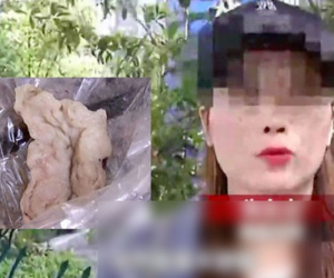 6 tháng sau khi nâng mũi trăm triệu, cô gái trẻ hắt xì ra bông gạc đẫm máu