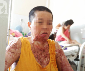 Người phụ nữ bị tình cũ tạt axit bỏng nặng sau khi níu kéo tình cảm không thành
