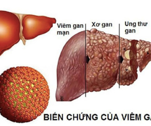 Viêm gan B lây lan nhanh hơn HIV gấp 100 lần, dùng chung bát đũa có lây?
