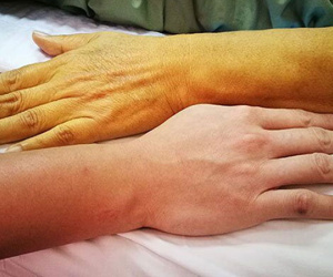 Ung thư tụy khó phát hiện sớm, dễ tử vong