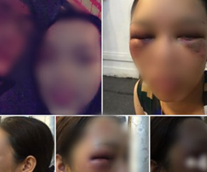 Sự thật bức ảnh cô dâu bị đánh thâm tím mặt mày vì tỏ thái độ 'lồi lõm', không cho chồng hôn ngay trong đám cưới