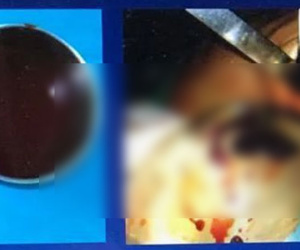 Ngực nữ doanh nhân Việt 33 tuổi sưng to như muốn nổ tung sau thẩm mĩ