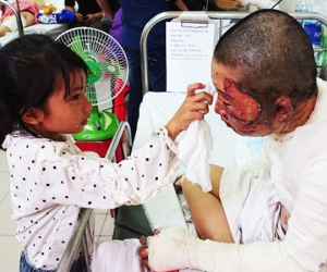 Bố dùng xăng đốt khiến mẹ biến dạng khuôn mặt, con gái 8 tuổi khóc ngất: 'Mẹ có xấu nhưng con vẫn nhận ra mẹ mà'